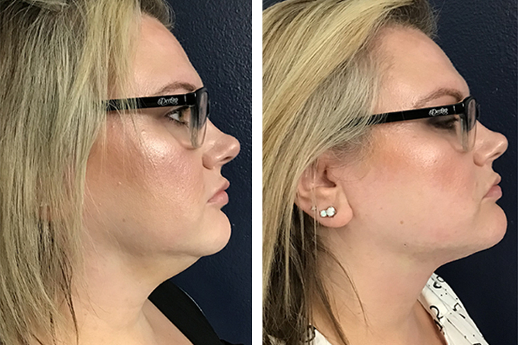 Side-by-side profile views of a woman with blonde hair wearing black glasses, showing her left and right side. She has a slight smile and is against a blue wall background.