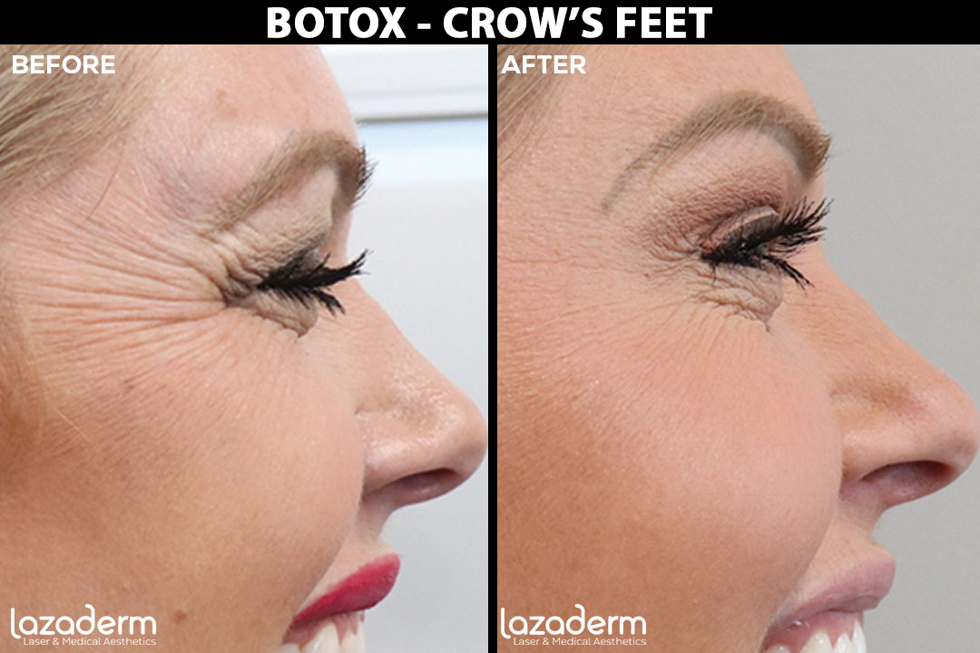 Before and after results of botox on Crows Feet