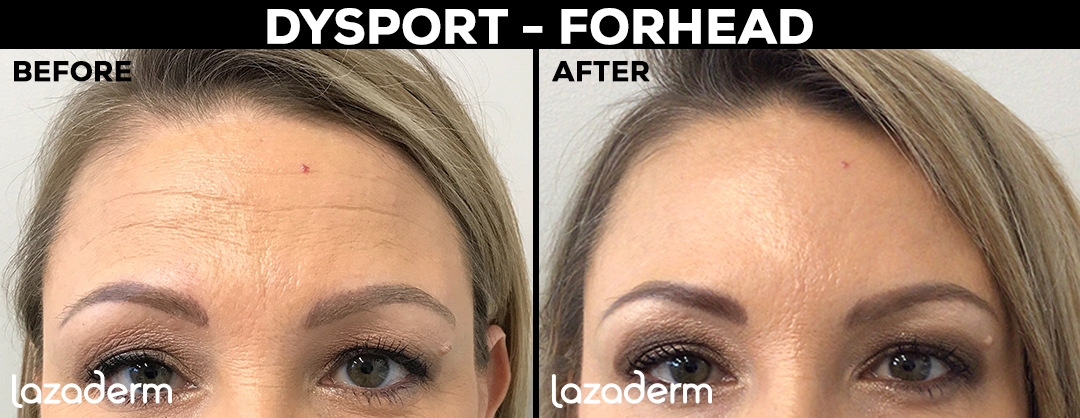 Before and after results of dysport injection to smooth lines and wrinkles in the forehead