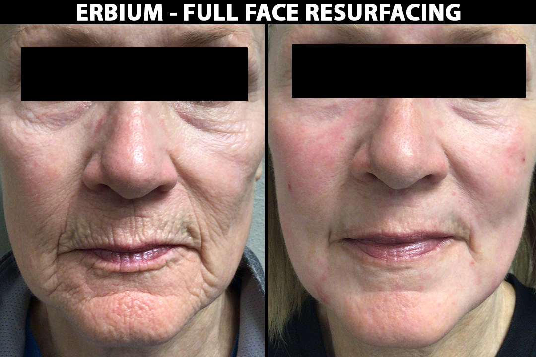 Before and after of face resurfacing at Lazaderm