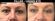 Before an after of a non-surgical eye lift at Lazaderm