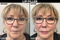 Before and after of a women's lips who had filler injected at Lazaderm