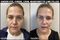 Before and after of a woman who had Under Eye - Cheek- Chin - Marionette Line Fillers at Lazaderm