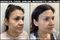 Before and after of a woman who had fillers at Lazaderm