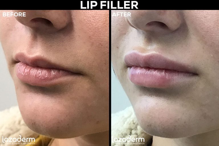 Before and After of Juvederm used for lip filler at Lazaderm