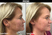 Before and after of a patient who recieved the moxi laser treatment at Lazaderm