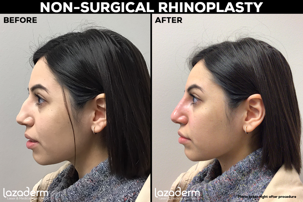 Side-by-side before and after images of a woman who has undergone non-surgical rhinoplasty. In the before image to the left, her nose has a noticeable bump, while in the after image to the right, the bump appears smoother and less pronounced. Both images show her profile view.