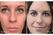 Side-by-side comparison of a woman's face before and after treatment, showing reduced under-eye bags and overall rejuvenated appearance.