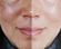 Before and After picture of skin treatment