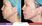 Side-by-side images of a woman's profile before and immediately after a Y Lift cosmetic procedure, showing marked improvements in facial contours and skin tightness.
