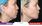 Side-by-side photos of a woman's profile before and the day after a Y Lift cosmetic procedure, showing visible facial rejuvenation and contouring improvements.