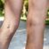 A close-up image of two legs standing outdoors on a gravel path. The left leg has visible varicose veins, while the right leg appears smoother with fewer visible veins. Greenery and sunlight can be seen in the background.