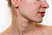 Close-up of a young woman's profile showing acne on her cheek and jawline, against a white background.