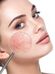 Close-up of a woman's face with clear skin; a magnifying glass shows a section of her cheek with visible red capillaries to illustrate skin issues.