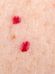 Close-up image of human skin with two small, red, raised spots. The surrounding skin appears slightly textured and has a few light brown spots.