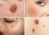 A collage of four images showing different skin conditions. Top left: a raised brown mole on hairy skin. Top right: a close-up of a person's cheek with a dark pigmented patch. Bottom left: age spots on the cheek of an older person. Bottom right: two raised brown moles.