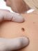 A close-up of a person's shoulder with a gloved hand examining a dark mole. The person's skin appears light, and they have light blonde hair. The focus is on the mole, suggesting a medical examination.