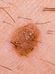 Close-up image of a mole on human skin. The mole is slightly raised, brown, and rough in texture, and there are several hairs nearby.