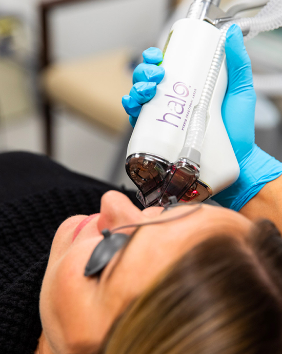 Halo Laser Treatment on patient at Lazaderm