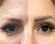 Botox Before and After