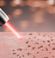 Close-up of a laser removing pigmentation from human skin. The laser beam touches the skin's surface, targeting dark spots, with a blurred background. The skin shows signs of partial clearing where the laser has passed, highlighting the treatment process.